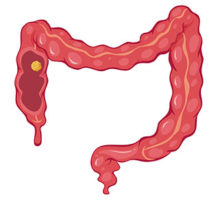 What can I take to prevent colorectal cancer?