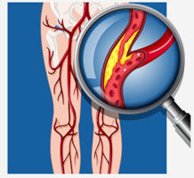 How to avoid peripheral arterial disease