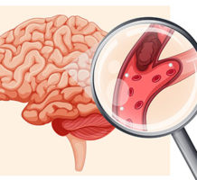 Ministrokes warn of worse stroke to come