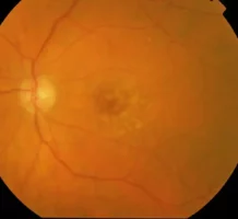 Facing age-related macular degeneration