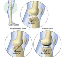 Understanding knee replacement surgery